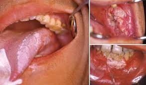 cancer-amravati-mandal