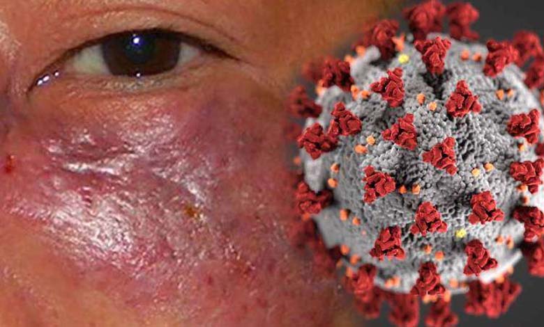 mucormycosis-amravati-mandal