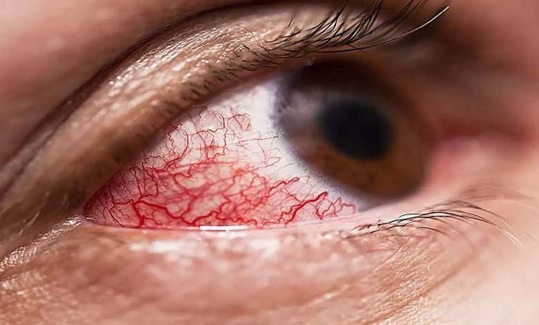 mucormycosis-amravati-mandal