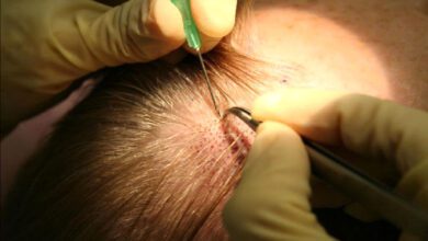 hair-transplantation-amravati-mandal